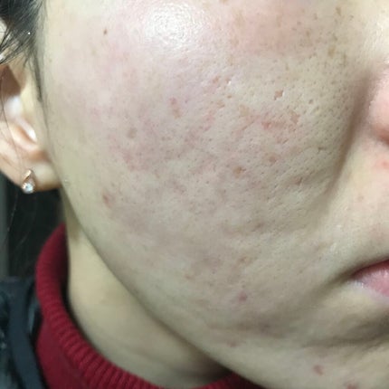 ティーツリーケア ソリューション エッセンシャルマスクEX/MEDIHEAL/シートマスク・パックを使ったクチコミ(1枚目)