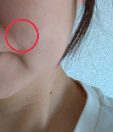 極薄透明パッチ nikipa!/金冠堂/にきびパッチを使ったクチコミ(6枚目)