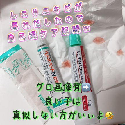 ベトネベートN軟膏AS(医薬品)/第一三共ヘルスケア/その他を使ったクチコミ(1枚目)