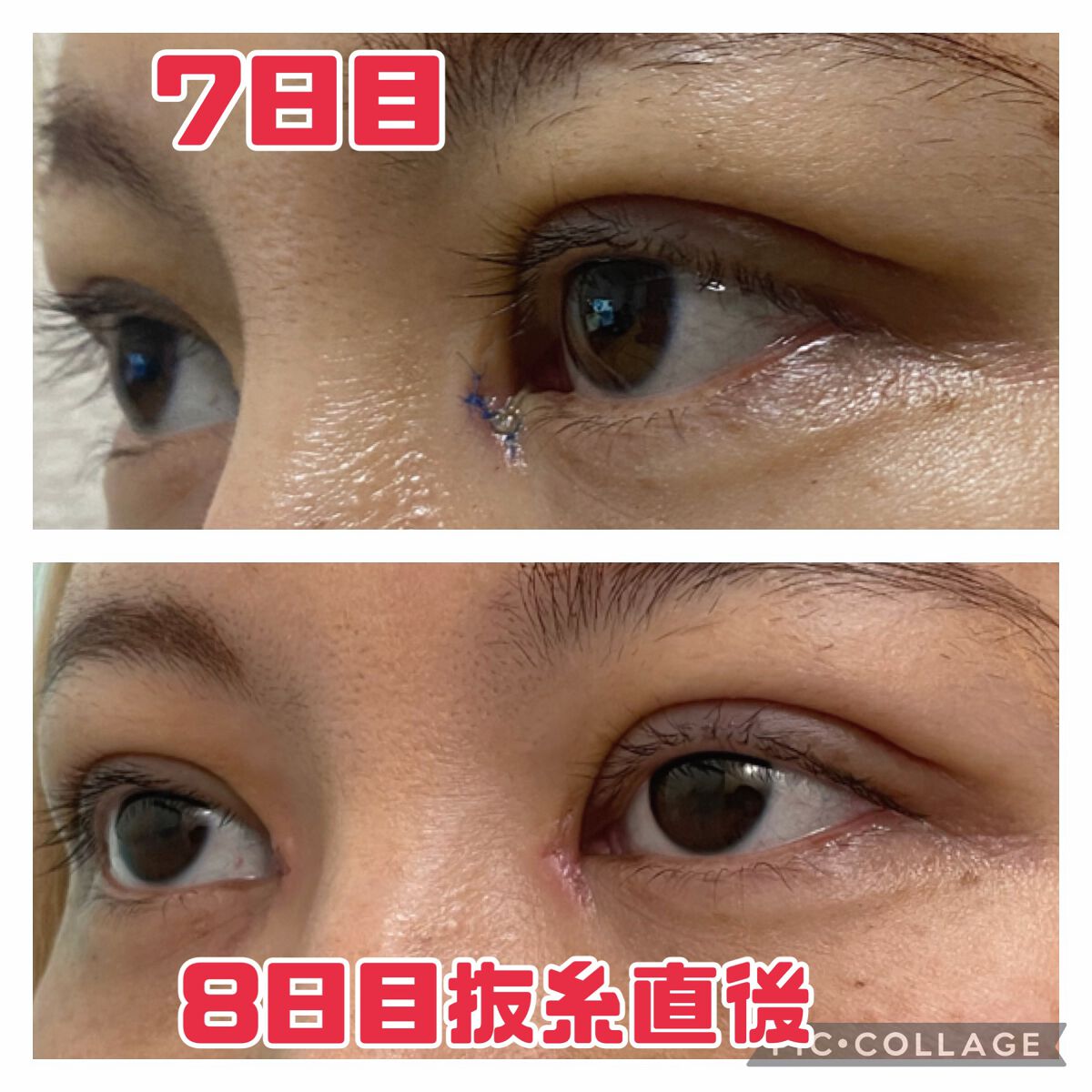ふうせん @フォロバ100% on LIPS 「3月3日8日目抜糸の日抜糸直後なので少し赤みがあるかもしれない..」(3枚目)