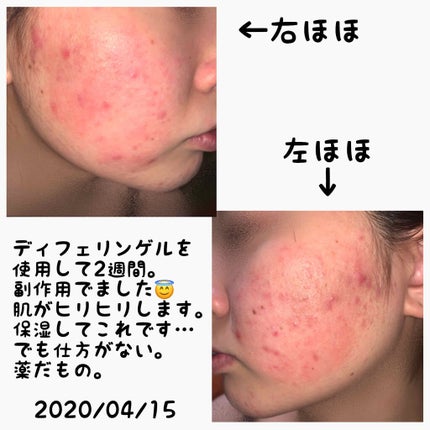 オードムーゲ 薬用ローション(ふきとり化粧水)/オードムーゲ/拭き取り化粧水を使ったクチコミ(3枚目)