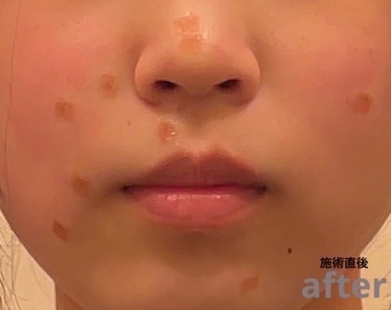 セノ on LIPS 「お久しぶりですセノです!念願のほくろ取り行ってきたので記録とし..」(4枚目)