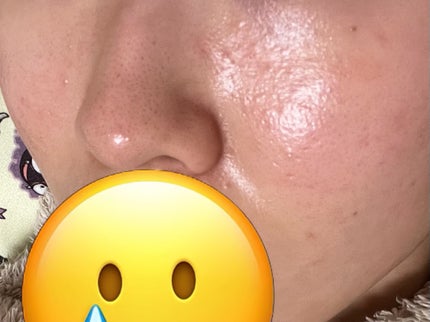 ミノン アミノモイスト 薬用アクネケア ローション/ミノン/化粧水を使ったクチコミ(2枚目)