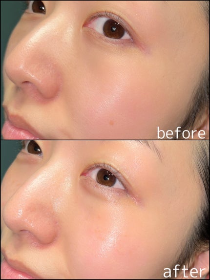 Wonder Ceramide Mochi Toner(トニーモリーワンダーCモチトナー)/TONYMOLY/化粧水を使ったクチコミ(5枚目)