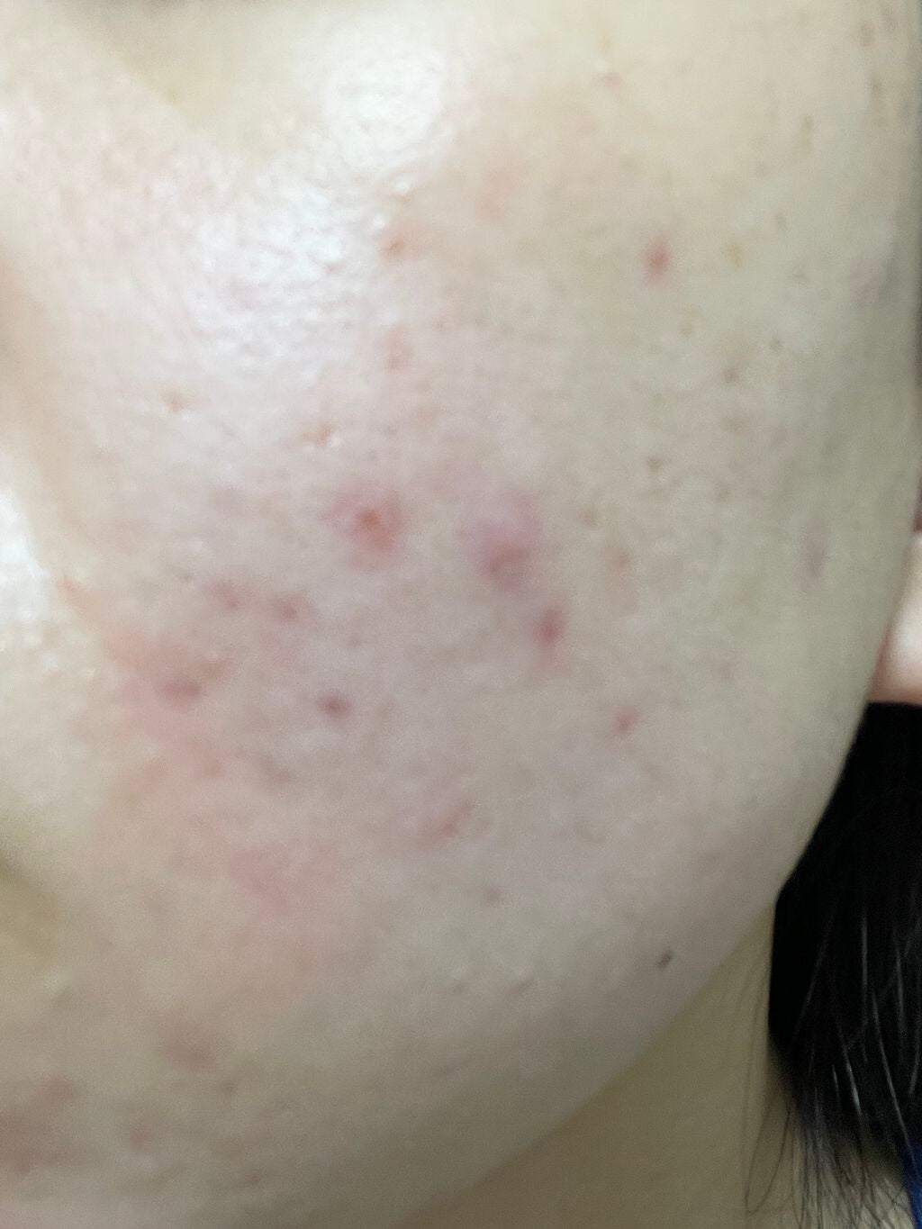 まままこ on LIPS 「ニキビゼロ肌を目指して〜8日目〜⚠️2枚目から肌画像ありスキン..」(3枚目)