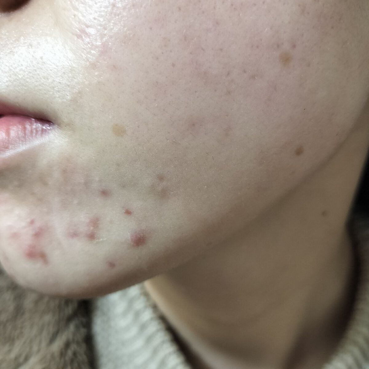 テラ・コートリル 軟膏(医薬品)/ジョンソン・エンド・ジョンソン/その他を使ったクチコミ（2枚目）