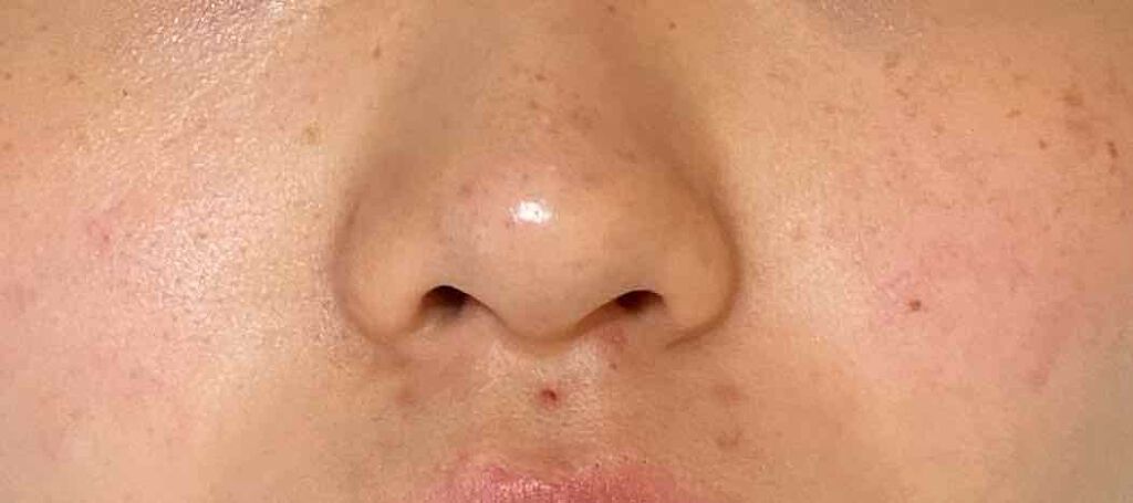 なさ on LIPS 「コメントお願いします🥺肌のことで悩んでいます。ニキビ、ニキビ跡..」(3枚目)