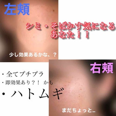 🍎 on LIPS 「シミ・そばかすを気にしてる方閲覧注意⚠️⚠️⚠️ごめんなさい🙏..」（1枚目）