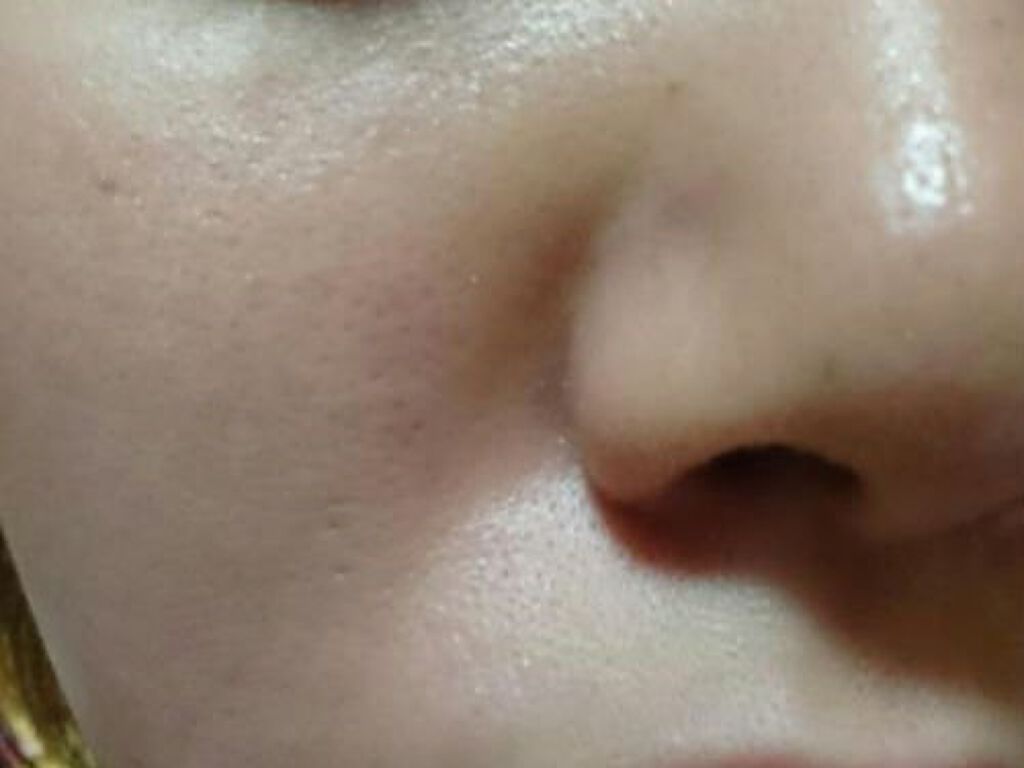 にこ on LIPS 「黒ずみ毛穴とニキビあとに困ってます。普段は洗顔がビオレのニキビ..」(1枚目)