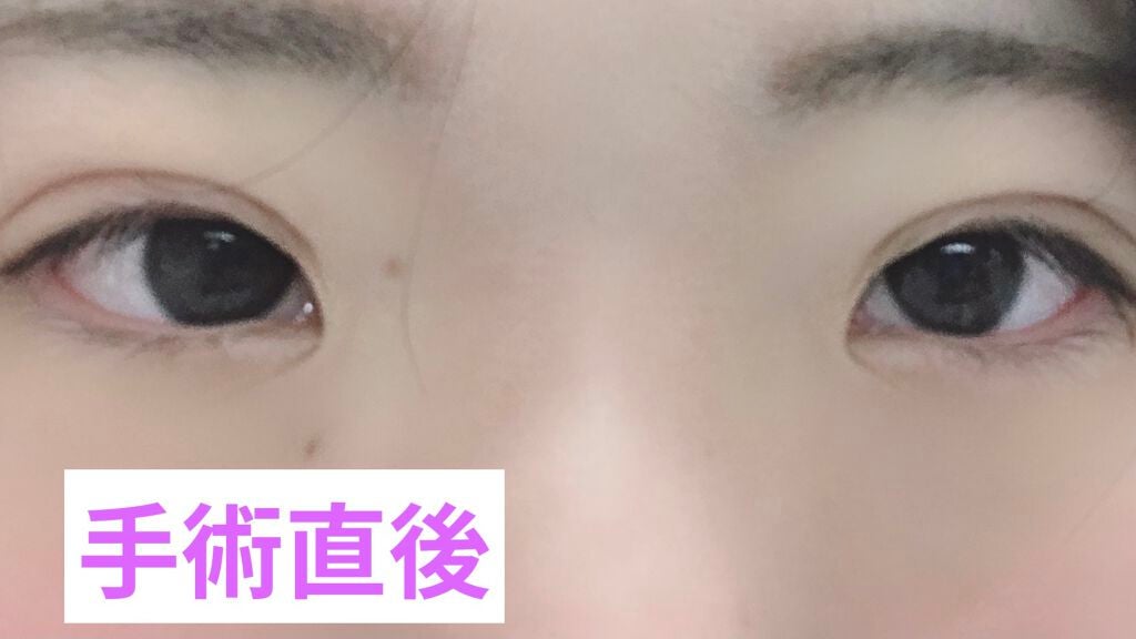 ⚡️あが⚡️ on LIPS 「二重整形:埋没法♡城本クリニックにて♡二重整形:埋没法3点止め..」(2枚目)