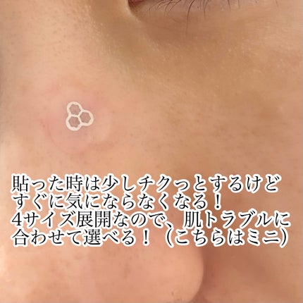 ACマグネシウムパッチ ミニ/スノーツープラス/にきびパッチを使ったクチコミ(4枚目)