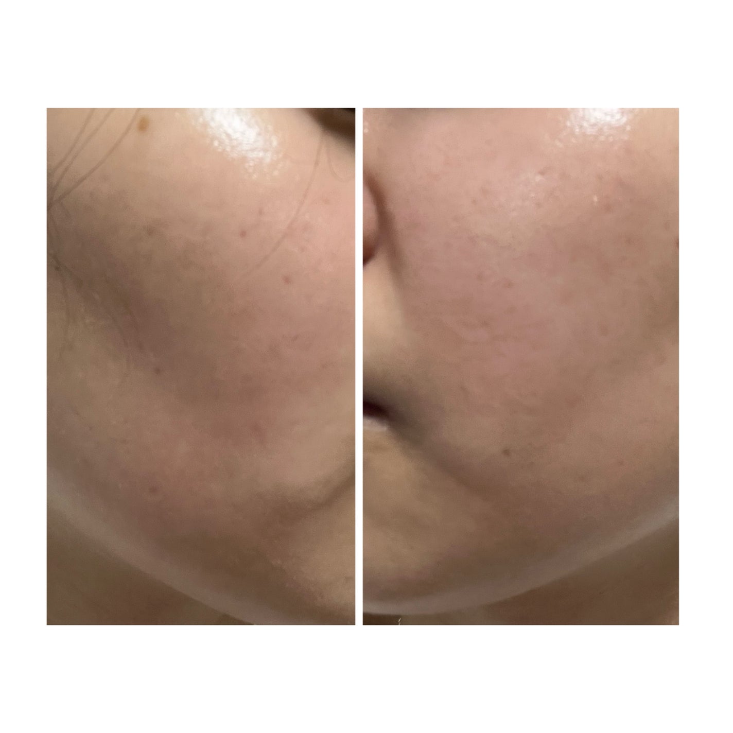 ぽむ on LIPS 「2023.9.13皮膚科に受診 エピデュオとヘパリン処方1枚目..」(4枚目)