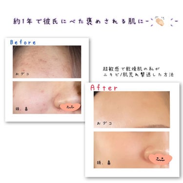 らんぼ🍒 on LIPS 「私流🌟お金をかけずに実践できる！肌荒れ/ニキビを撃退した方法🗒..」（1枚目）