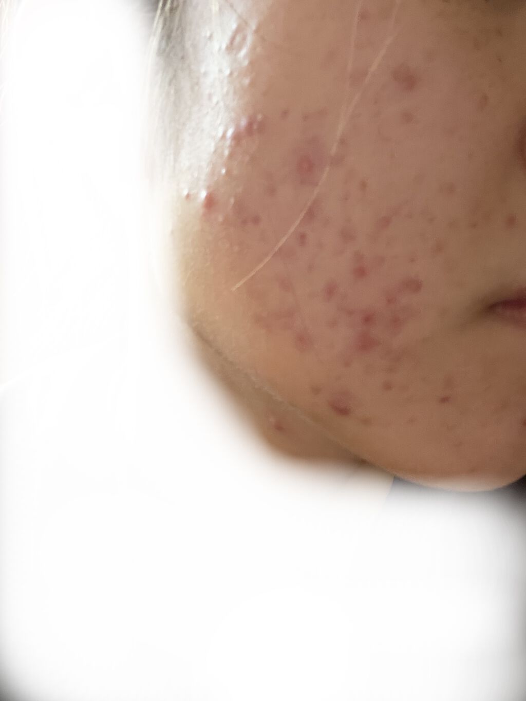 オードムーゲ 薬用ローション（ふきとり化粧水）/オードムーゲ/拭き取り化粧水を使ったクチコミ（2枚目）