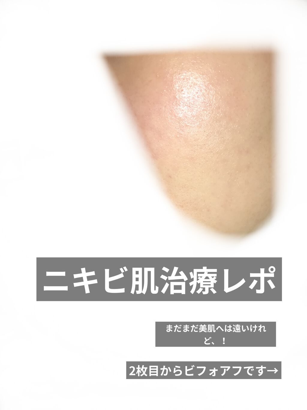 ノブ Ａ アクネソープ/NOV/洗顔石鹸を使ったクチコミ（1枚目）