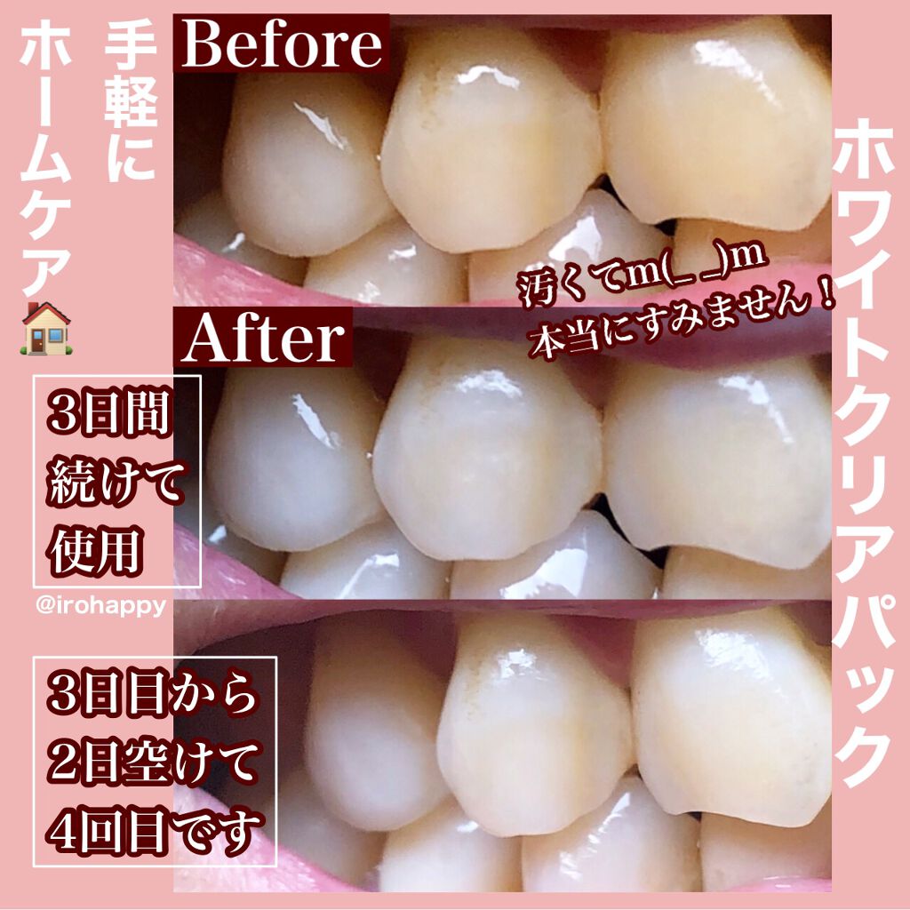 ã¯ãªã¢ã¯ãªãŒã³ ãã¬ãã¢ã ãã¯ã€ãã¯ãªã¢ããã¯ããã¬ã/ã¯ãªã¢ã¯ãªãŒã³/ãã®ä»ãªãŒã©ã«ã±ã¢ã䜿ã£ãã¯ãã³ãïŒ5æç®ïŒ