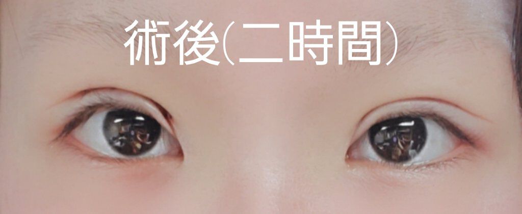 二重整形/その他を使ったクチコミ（3枚目）