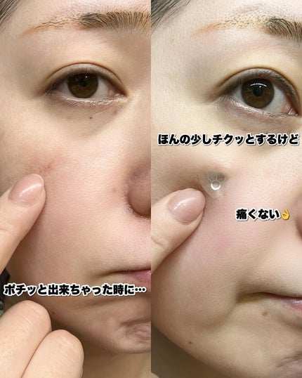 ACマグネシウムパッチ ミニ/スノーツープラス/にきびパッチを使ったクチコミ(6枚目)