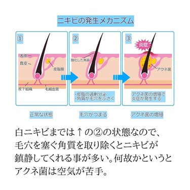 ナリス化粧品 アクネグラン 薬用 クリーミー ウォッシュのクチコミ「元ニキビ肌の経験からニキビに悩む人向けのおすすめ洗顔料を紹介。

白ニキビはサリチル酸など角質.....」（3枚目）