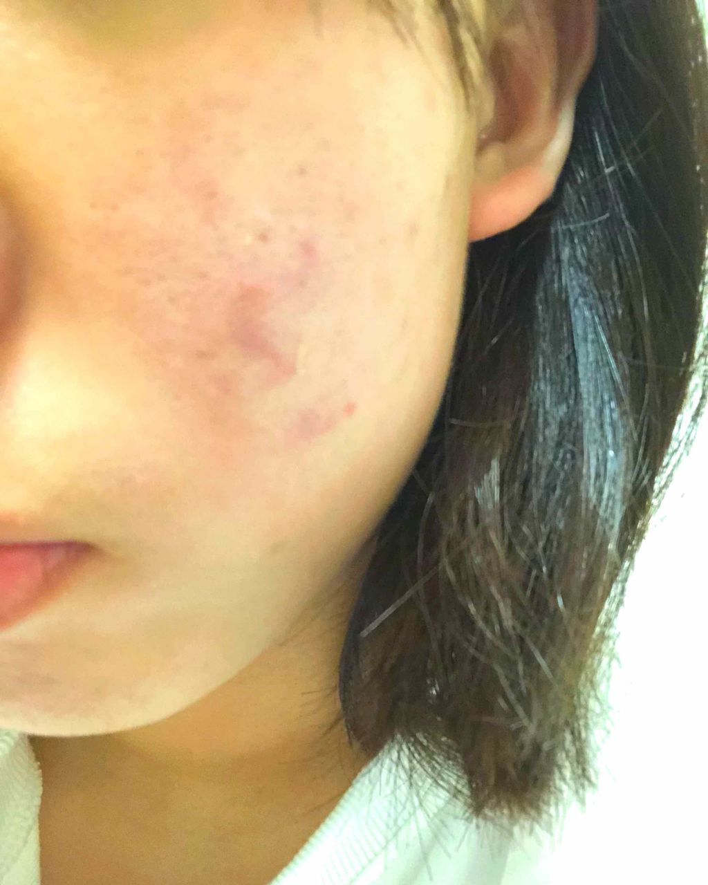 バイオイル/バイオイル/フェイスオイルを使ったクチコミ（3枚目）