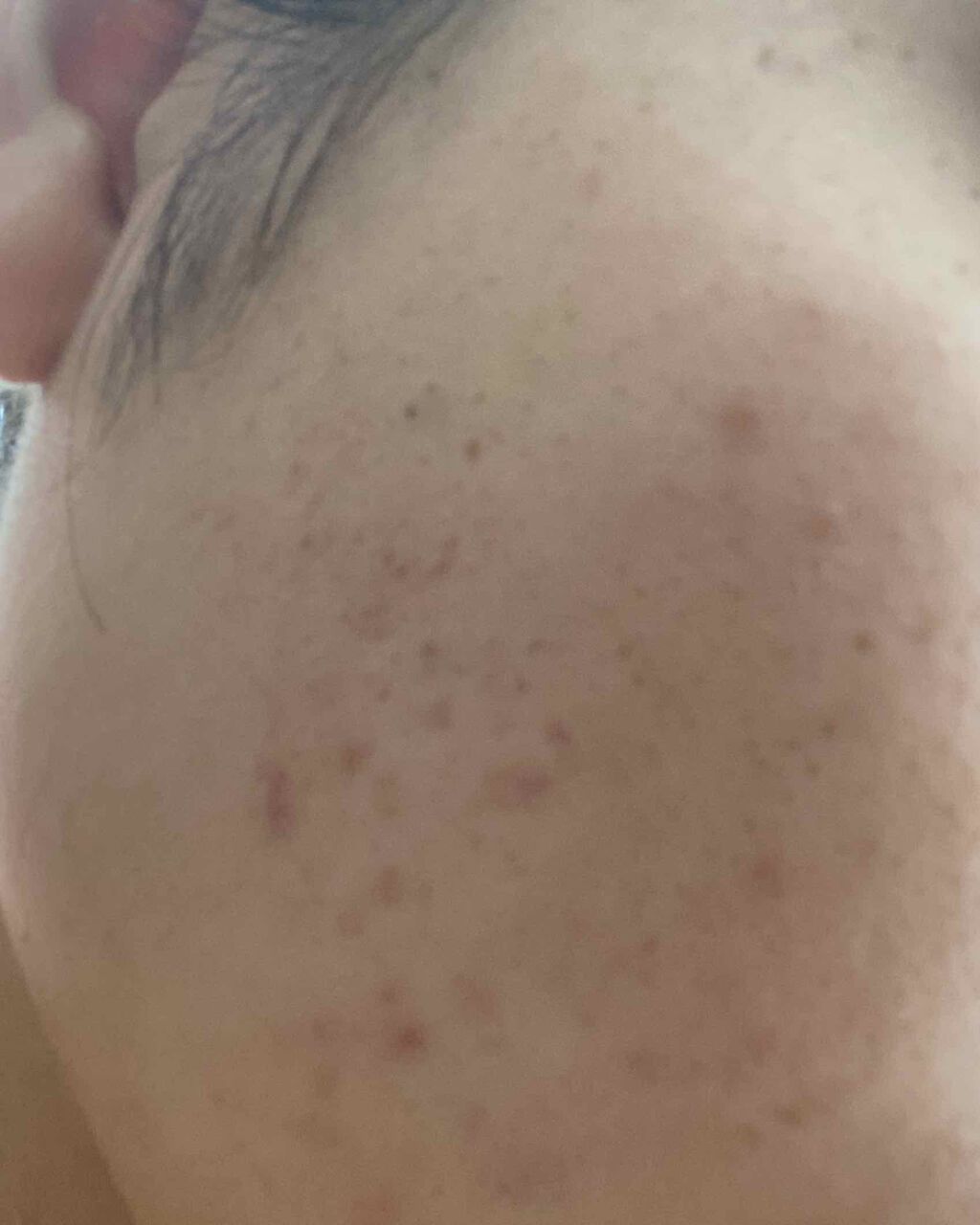 ゆいにゃー😸 on LIPS 「昔ほど白いニキビはあんまり出ないんですがこれはニキビ跡?しかも..」(2枚目)