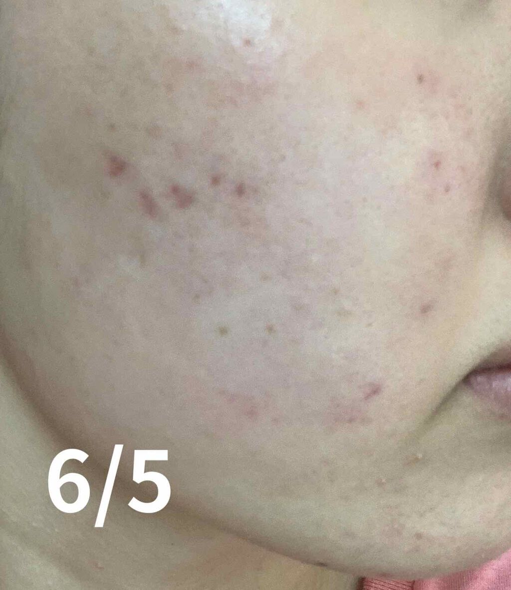 クリンダマイシンゲル(医薬品)/クラシエ薬品/その他を使ったクチコミ（2枚目）