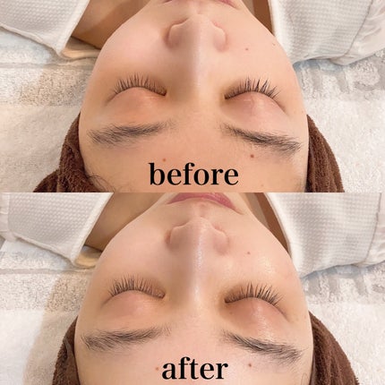 yuna** on LIPS 「エステサロンに行ってみた💨/施術・肌状態について詳しくレビュー..」(5枚目)