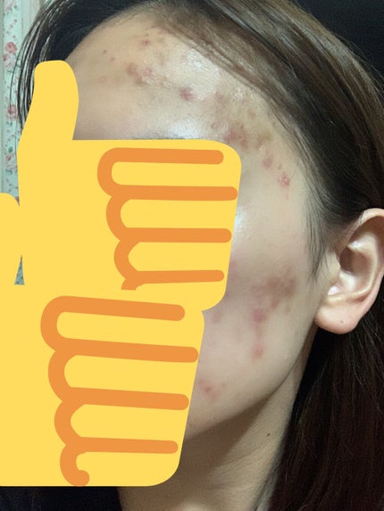 薬用ニキビケア スポッツクリーム/アクネスラボ/フェイスクリームを使ったクチコミ(3枚目)