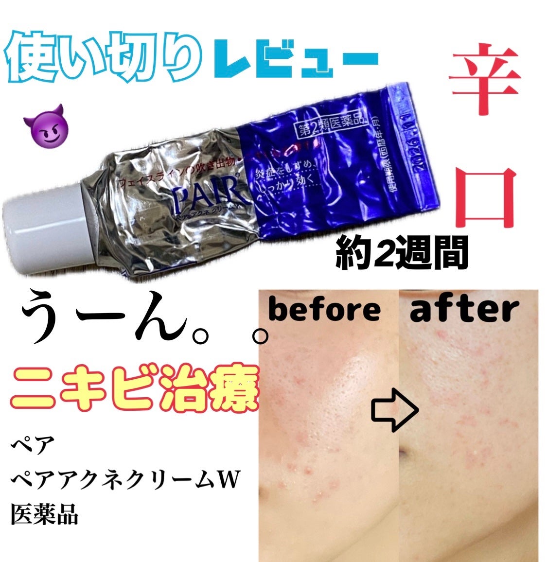 ペアアクネクリームW(医薬品)/ペア/その他を使ったクチコミ(1枚目)