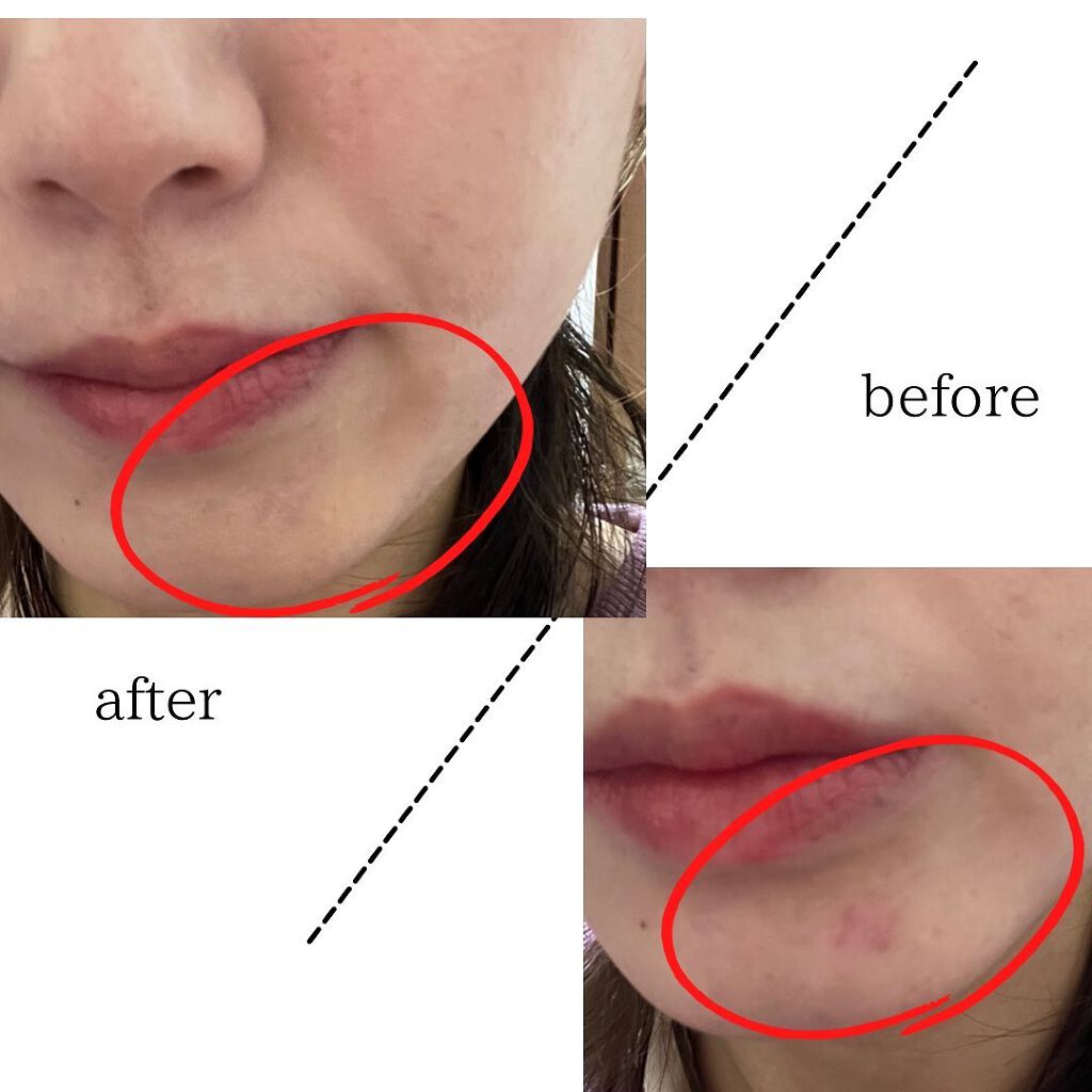 ソフトマットコンプリートコンシーラー 1282/NARS/クリームコンシーラーを使ったクチコミ（3枚目）