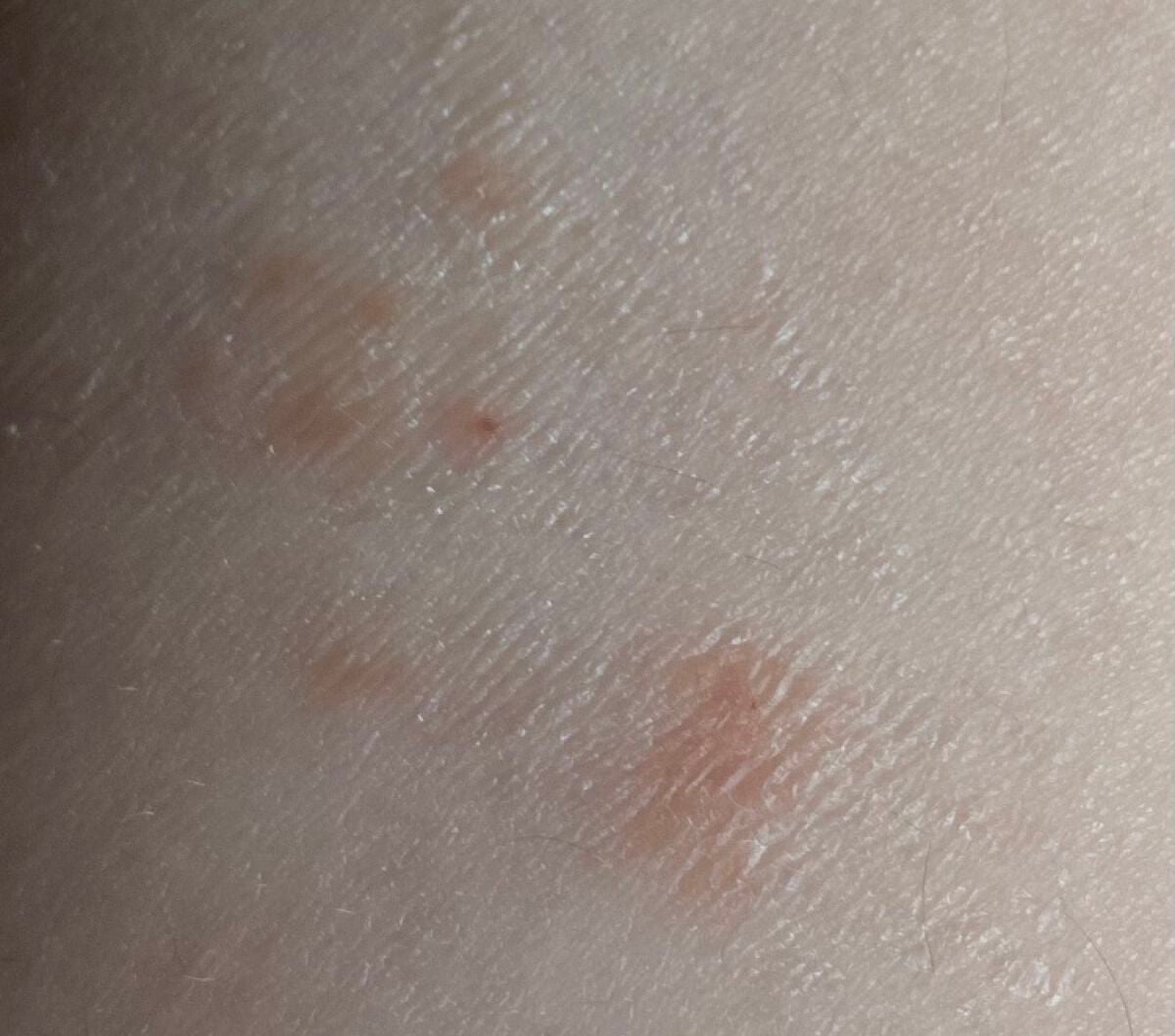 アットノンEX ジェル(医薬品)/アットノン/その他を使ったクチコミ(2枚目)