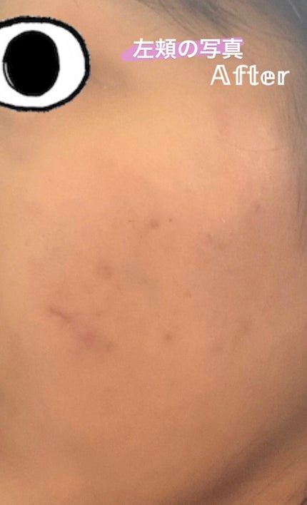 薬用 しみ 集中対策 美容液/メラノCC/美容液を使ったクチコミ(6枚目)