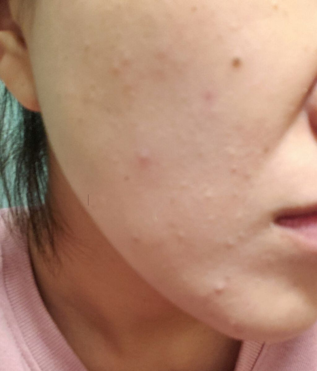 オードムーゲ 薬用ローション（ふきとり化粧水）/オードムーゲ/拭き取り化粧水を使ったクチコミ（1枚目）