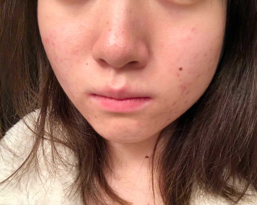 マンスリースキンケアプログラム(旧)/APEX/スキンケアキットを使ったクチコミ（2枚目）