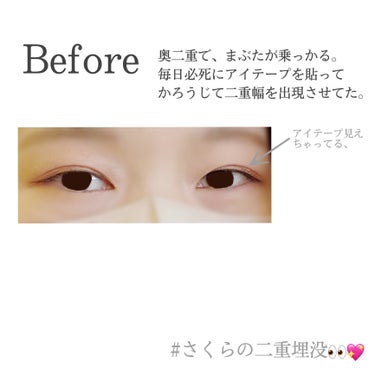 さくら🌸 on LIPS 「二重埋没体験記①👀💖(二重BeforeAfter)------..」（2枚目）