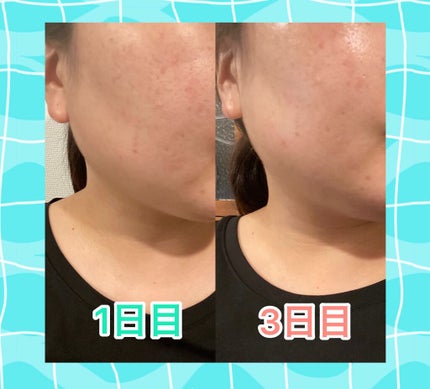 デリケートセット/エンビロン/スキンケアキットを使ったクチコミ(2枚目)