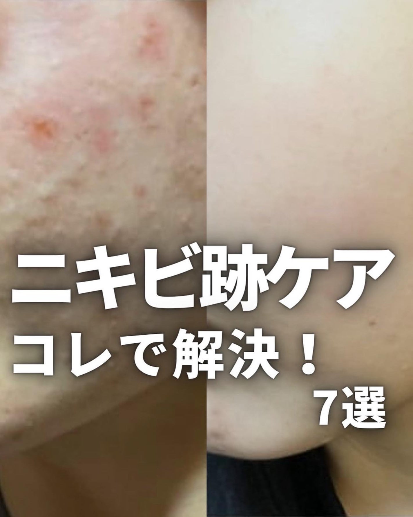 たー on LIPS 「他の投稿こちら💁♂️@mens_makeup1思春期の時にニ..」(1枚目)