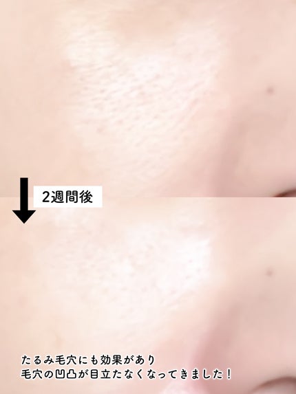 リードルショット100/VT/美容液を使ったクチコミ(6枚目)