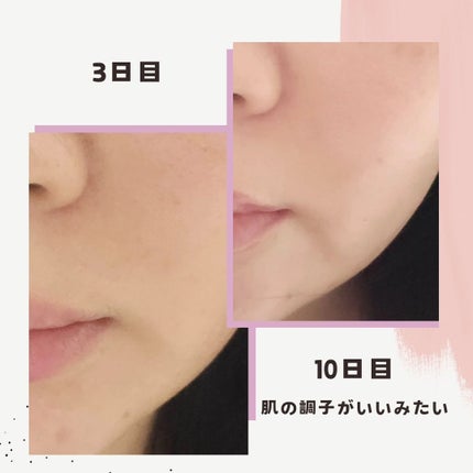 siki on LIPS 「ヒロクリニックフォトRF行ってきたよ!フォトって胸を先にやって..」(4枚目)