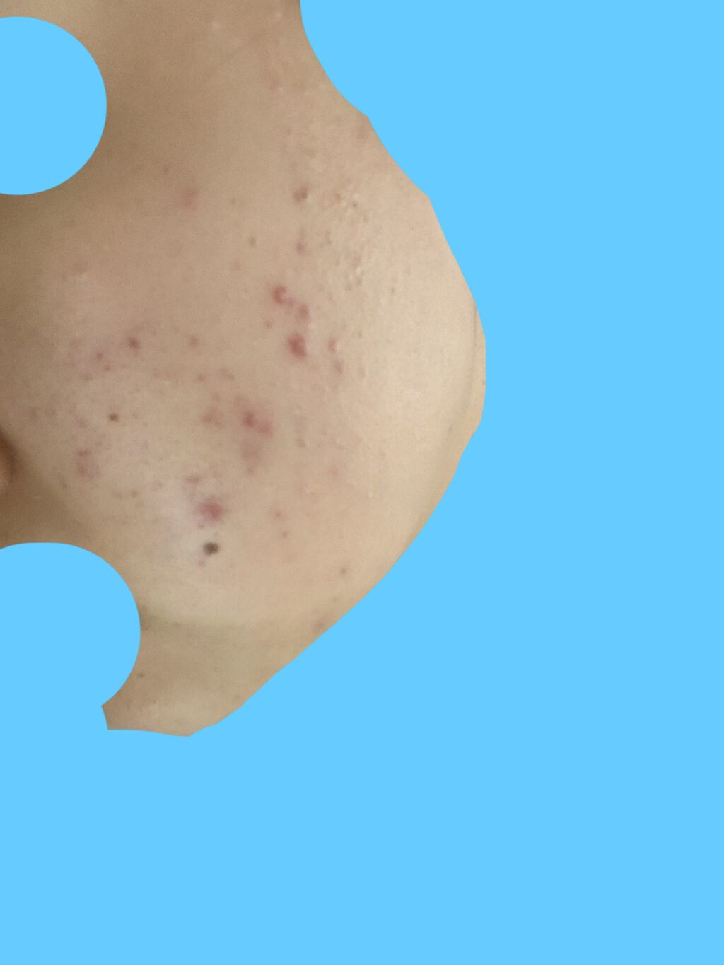 ペアアクネクリームW(医薬品)/ペア/その他を使ったクチコミ（2枚目）