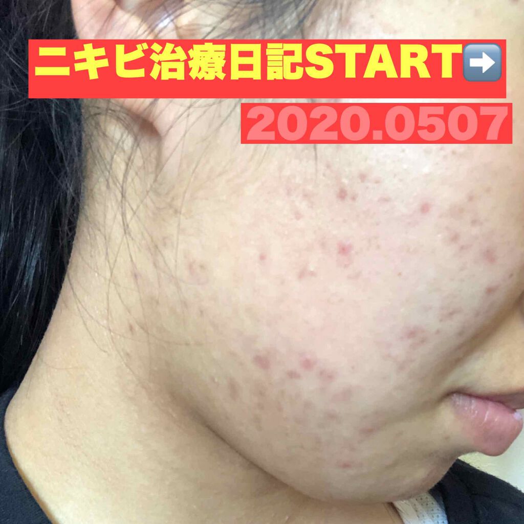 敏感肌用薬用美白美容液/無印良品/美容液を使ったクチコミ(1枚目)