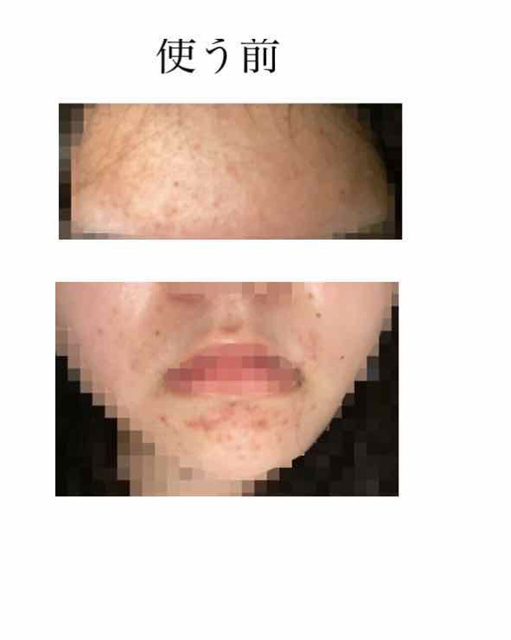 幸子 on LIPS 「皮膚科で貰ったエピデュオゲルを使用して1ヶ月後が経ったので、レ..」(2枚目)