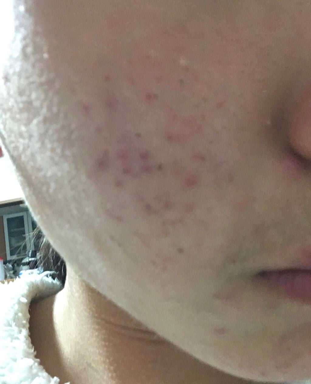 ペアアクネクリームW(医薬品)/ペア/その他を使ったクチコミ(3枚目)