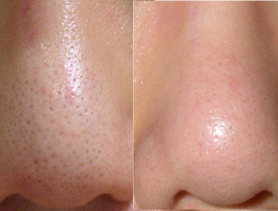 ボツルショット100/CELLINSHOT/ブースター・導入液を使ったクチコミ（1枚目）