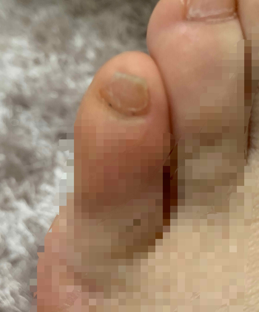 ディープセラム Dr Nailの口コミ こんにちは 足の小指の爪ボロボロな方いませ By Mina アトピー肌 10代後半 Lips