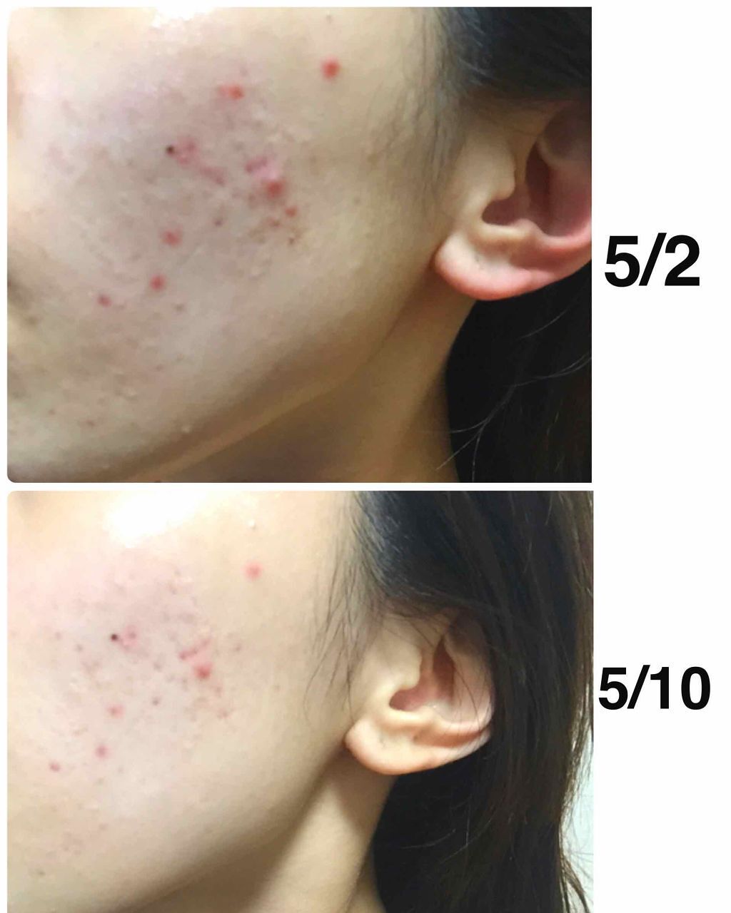 バイオイル/バイオイル/フェイスオイルを使ったクチコミ（2枚目）