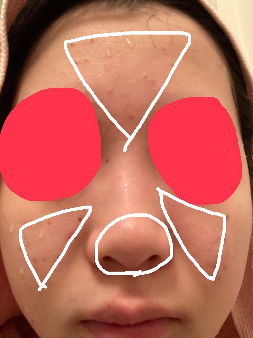 gloss_8 on LIPS 「ニキビと黒ずみ、変なブツブツに困っています使っているものトーン..」(3枚目)