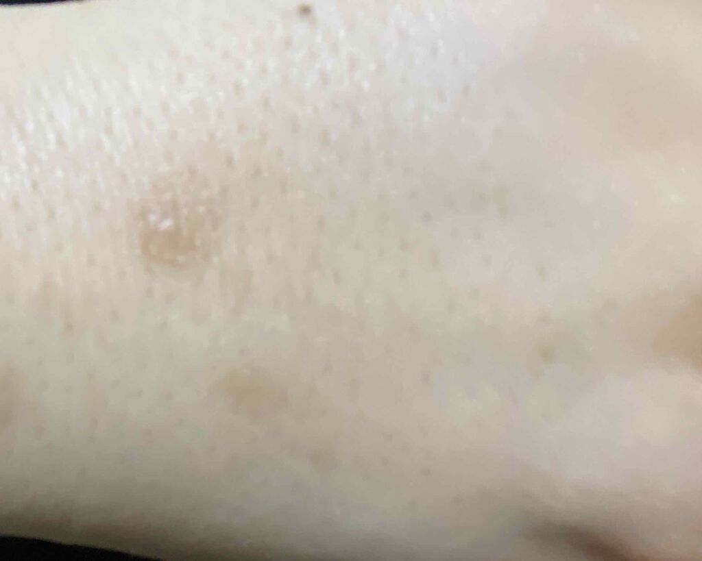 お亀ちゃん on LIPS 「手の毛穴と腕の毛穴と傷跡が泣きそうなくらい酷いです。ニベアとベ..」(2枚目)