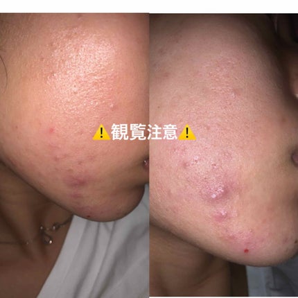 ハトムギ化粧水(ナチュリエ スキンコンディショナー R )/ナチュリエ/化粧水を使ったクチコミ(1枚目)