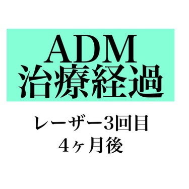 【ADM治療経過レーザー3回目4ヶ月後】

［画像２枚目］
4ヶ月後の左右

［画像３枚目］
レーザー照射3回目を打つ前と打ってから4ヶ月後の比較



だいぶ薄くなってきてるけど、まだコンシーラーして